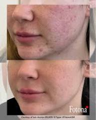 Acne Scar Laser Treatment