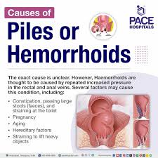Can Hemorrhoids Cause Constipation